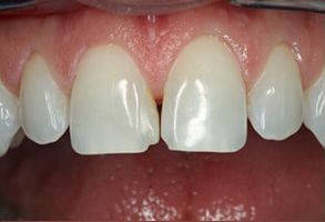 Granger Dentistry | Implant Dentistry, Implant Restorations and Dentures